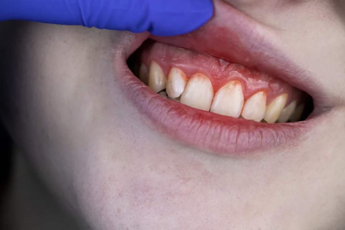 La causa principale di entrambe le patologie è l’accumulo di placca batterica e tartaro, conseguenza di una scarsa igiene orale.